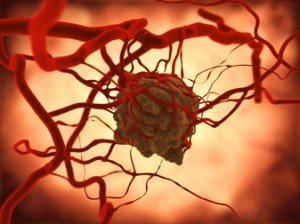 Figure 7. Artist’s representation of a tumor and its blood supply