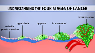Understanding the 4 Stages of Cancer Understanding the 4 Stages of Cancer