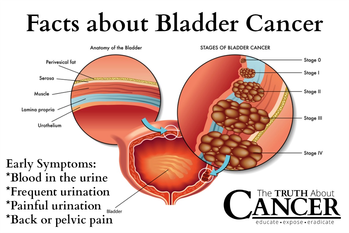 Overcoming Bladder Cancer 5893